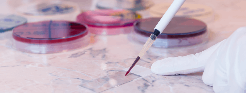 Sickle Cell Anemia (SCA)
